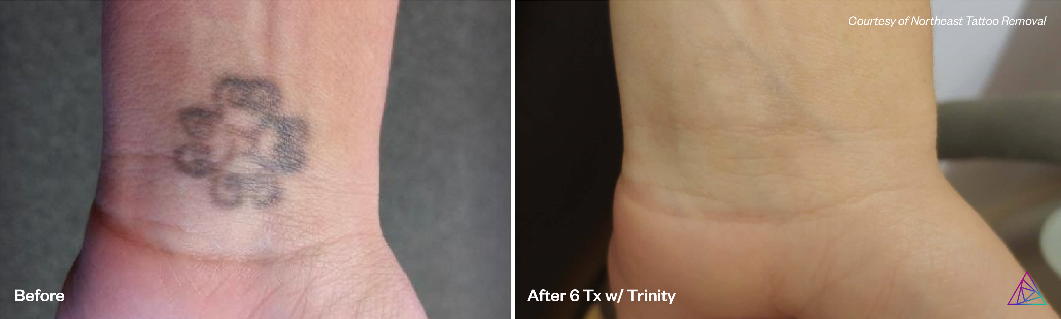 Before and after tattoo removal